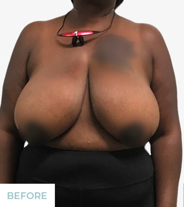 Breast Reduction before and after - before