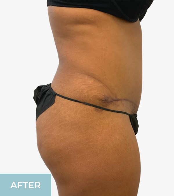 Tummy Tuck (Abdominoplasty) before and after - after
