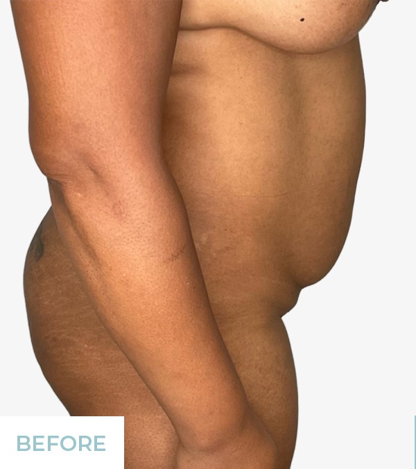 Tummy Tuck (Abdominoplasty) before and after - before