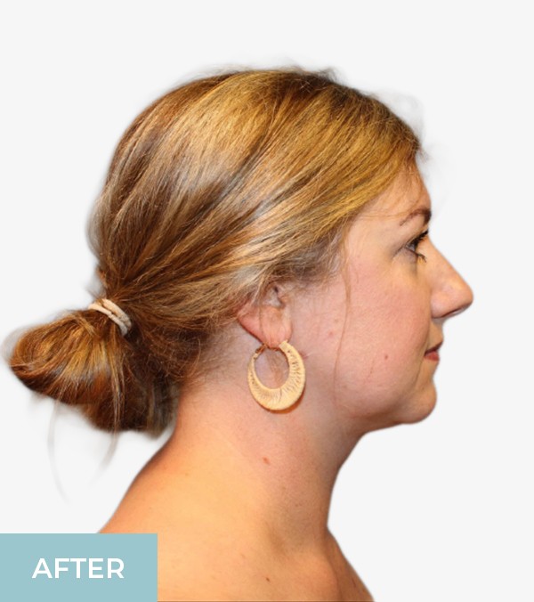 Liposuction before and after - after