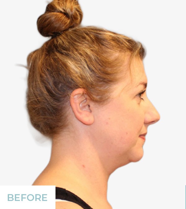 Liposuction before and after - before