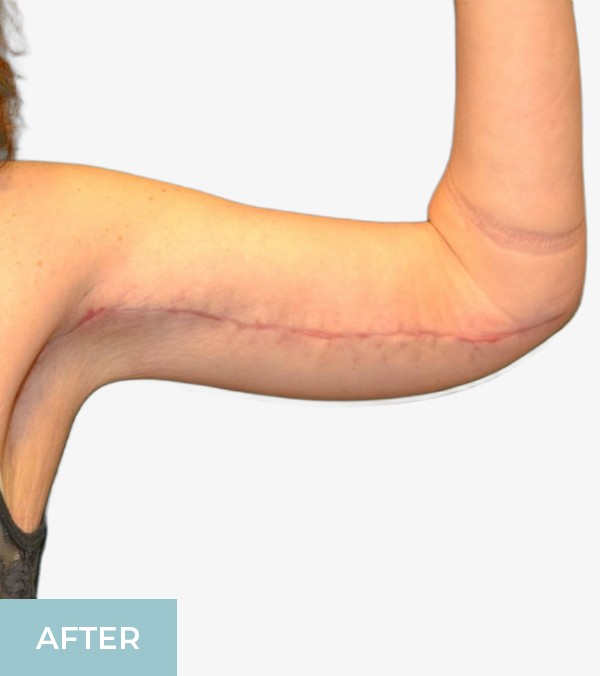 Arm Lift (Brachioplasty) before and after - after