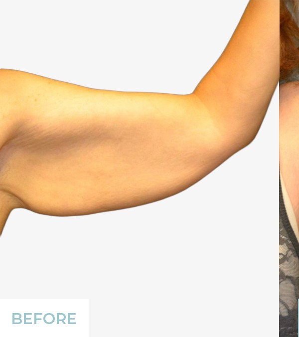 Arm Lift (Brachioplasty) before and after - before