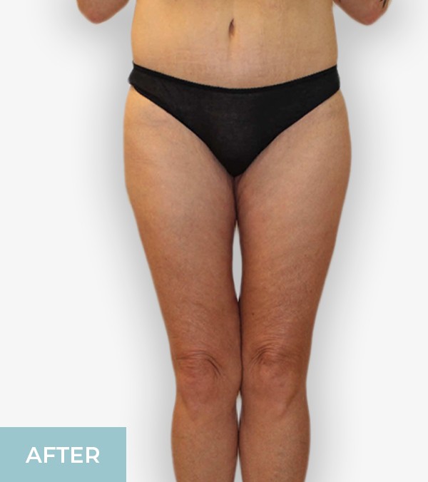 Thigh Lift (Thighplasty) before and after - after