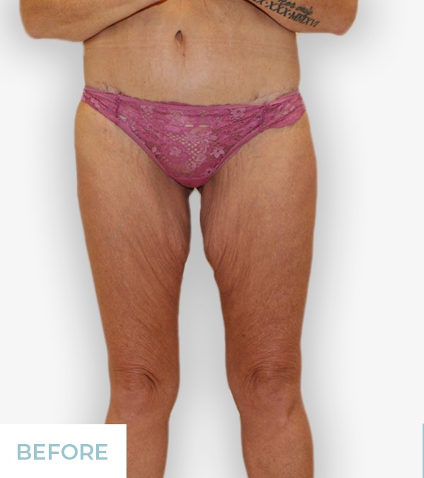 Thigh Lift (Thighplasty) before and after - before