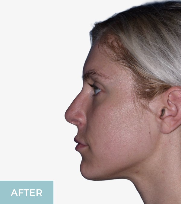 Rhinoplasty before and after - after