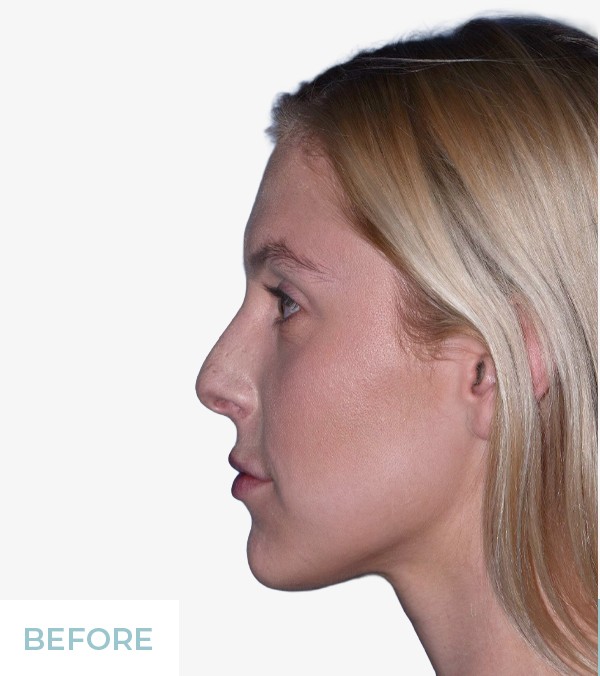 Rhinoplasty before and after - before