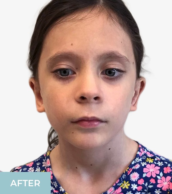 Otoplasty before and after - after