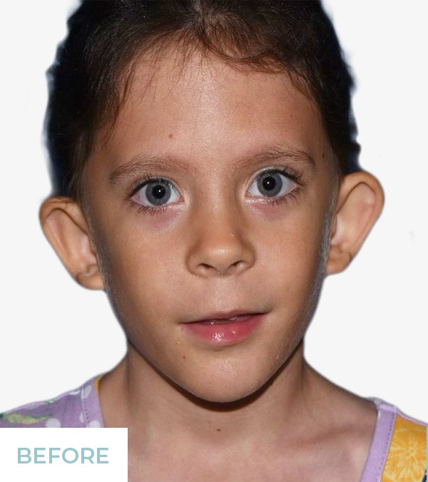 Otoplasty before and after - before