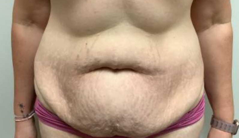 Abdominoplasty before and after - before