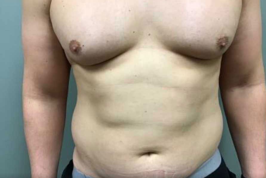 Liposuction before and after - before