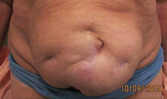 Abdominoplasty before and after - before