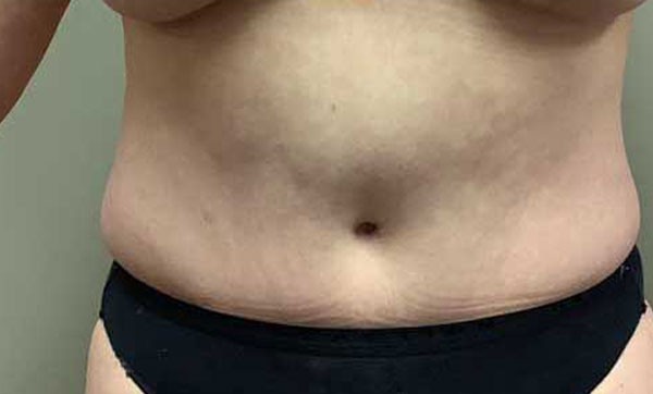 Abdominoplasty before and after - after