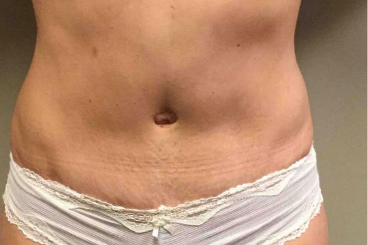 Abdominoplasty before and after - after