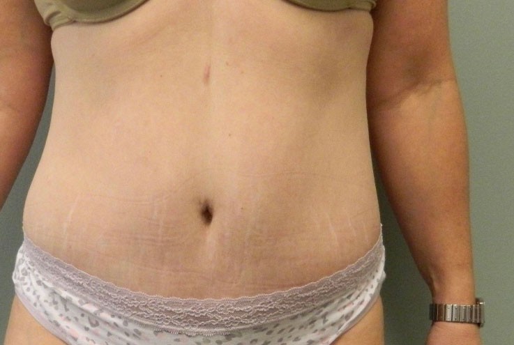 Abdominoplasty before and after - after