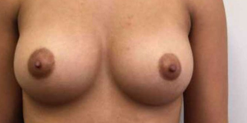 Breast Augmentation before and after - after