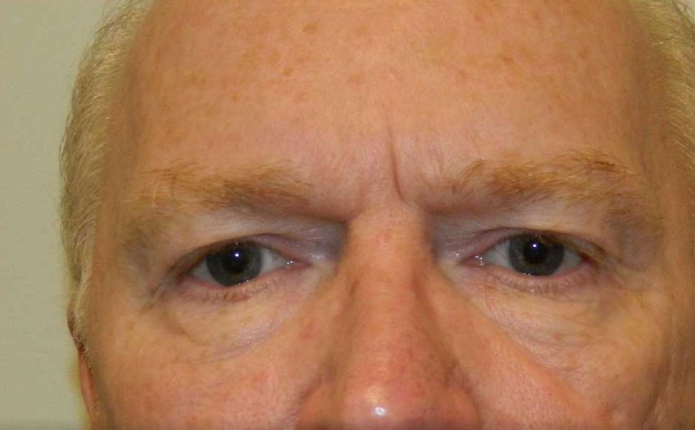 Eye Lift before and after - before