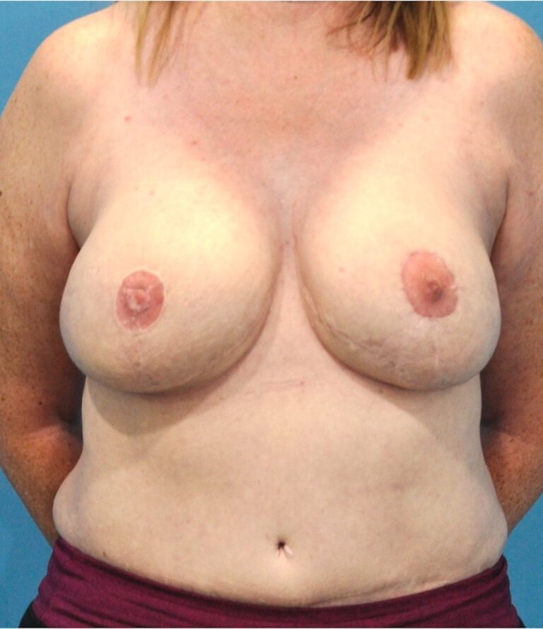 Procedure before and after - after