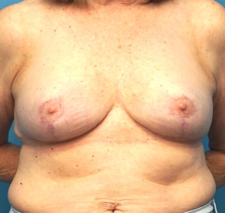 Breast Lift before and after - after