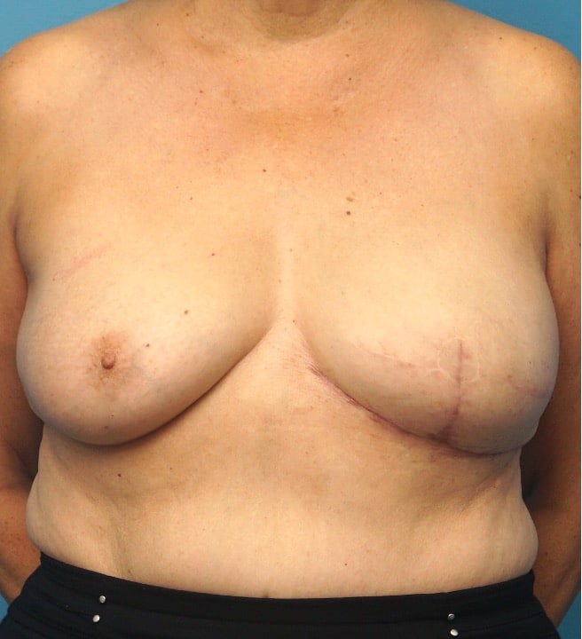 Procedure before and after - after