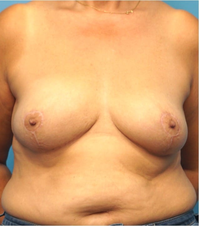 Procedure before and after - after