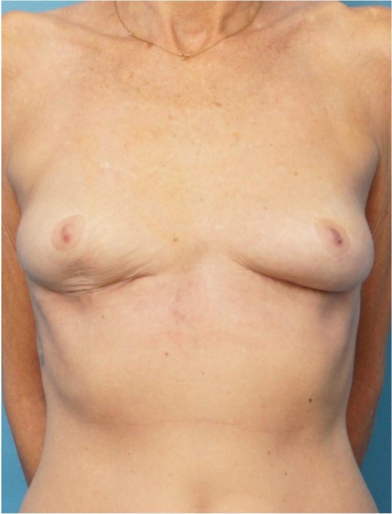 Breast Augmentation before and after - after