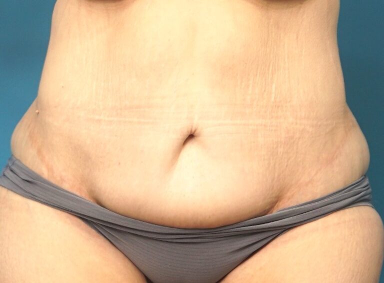 Tummy Tuck before and after - after