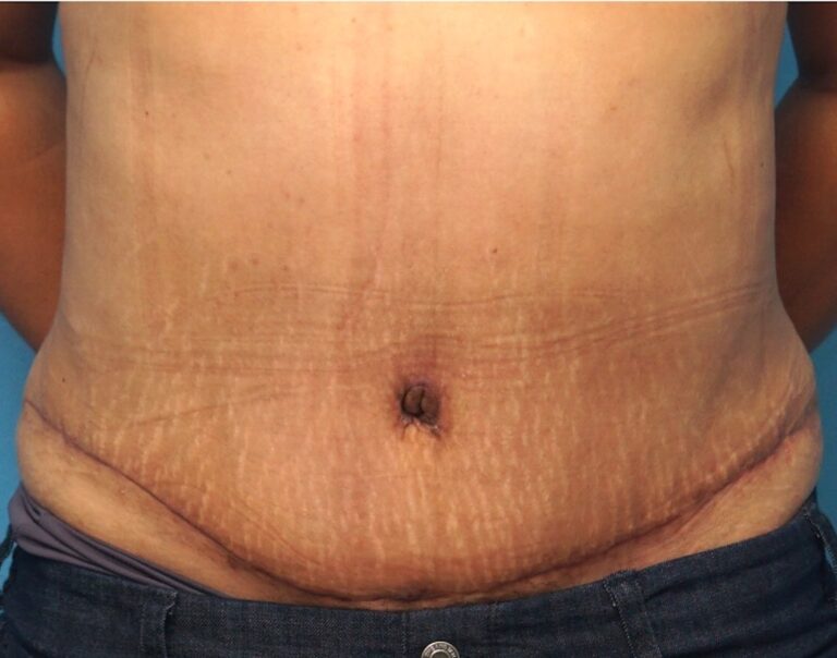 Tummy Tuck before and after - after