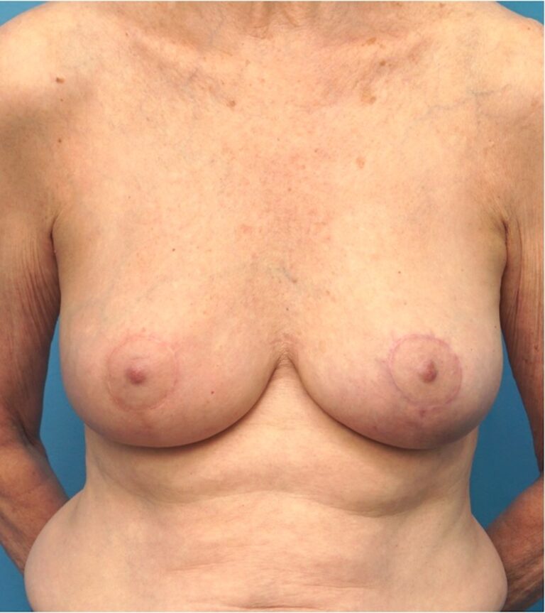 Procedure before and after - after