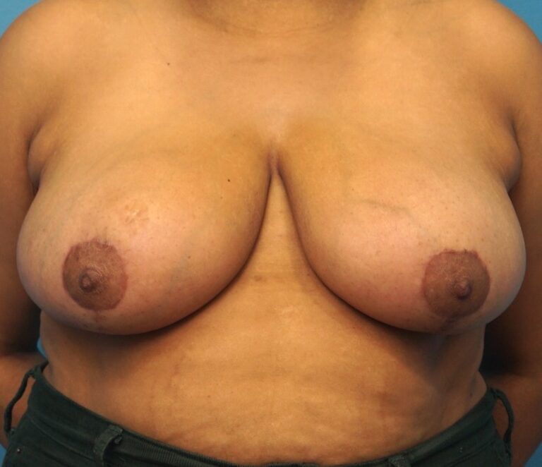 Procedure before and after - after