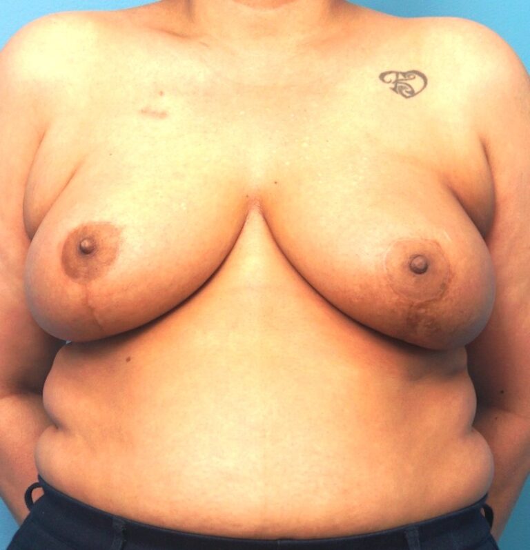 Procedure before and after - after