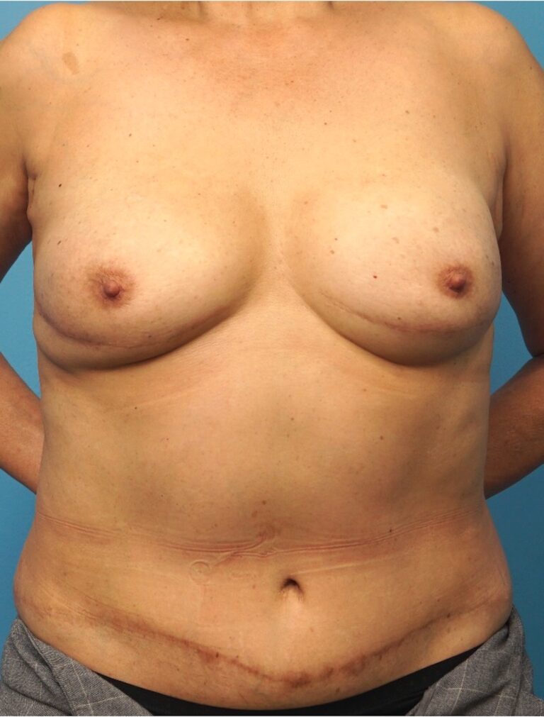 Procedure before and after - after