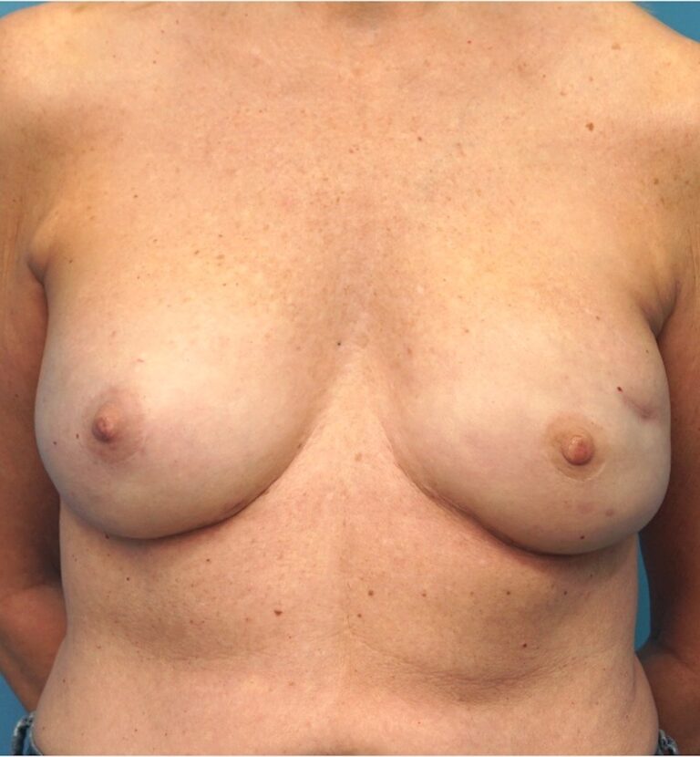 Procedure before and after - after