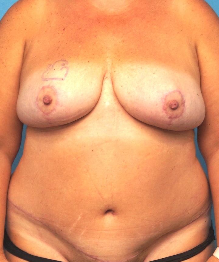 Procedure before and after - after