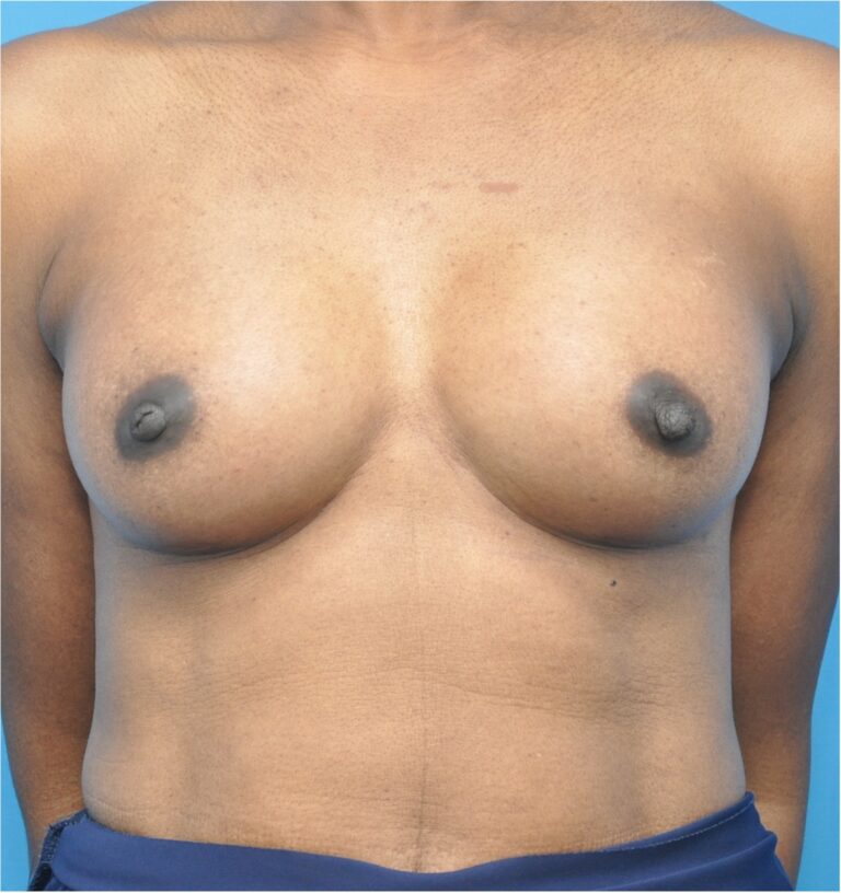 Breast Augmentation before and after - after