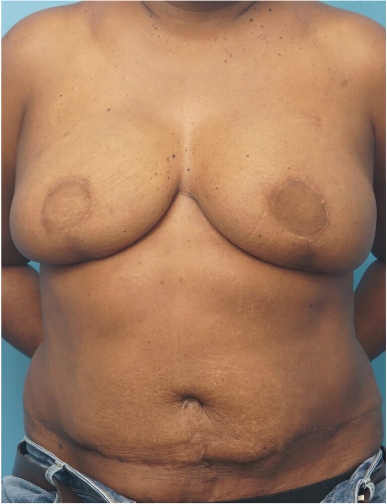Procedure before and after - after