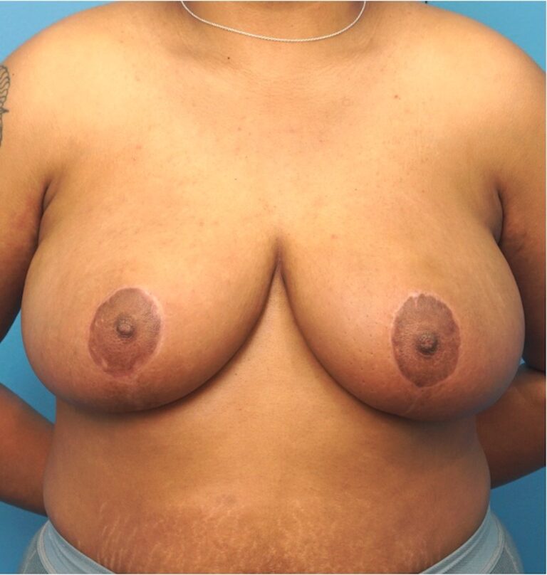 Procedure before and after - after