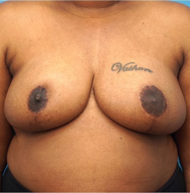 Procedure before and after - after