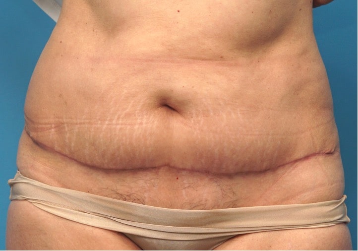 Tummy Tuck before and after - after