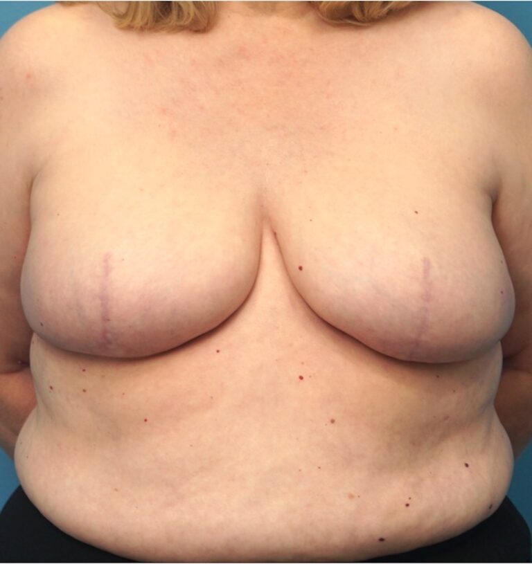 Procedure before and after - after
