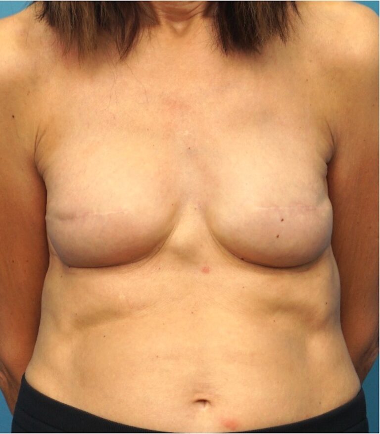 Procedure before and after - after