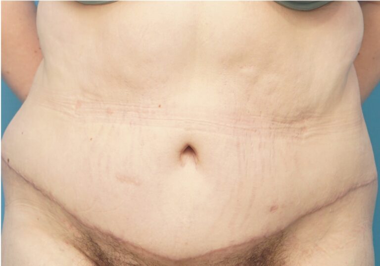 Tummy Tuck before and after - after