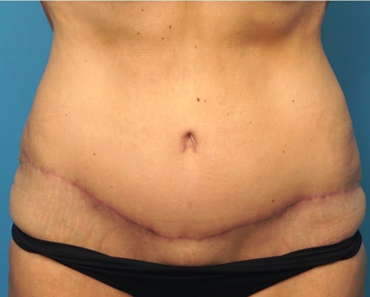Tummy Tuck before and after - after