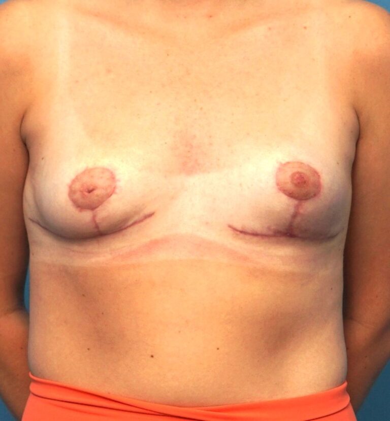 Breast Augmentation before and after - after