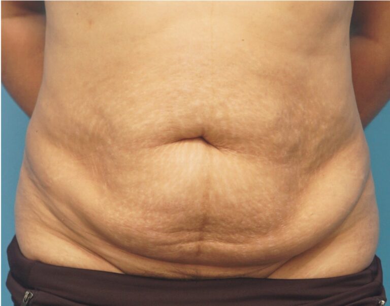 Tummy Tuck before and after - before