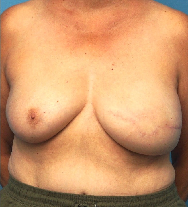 Procedure before and after - before