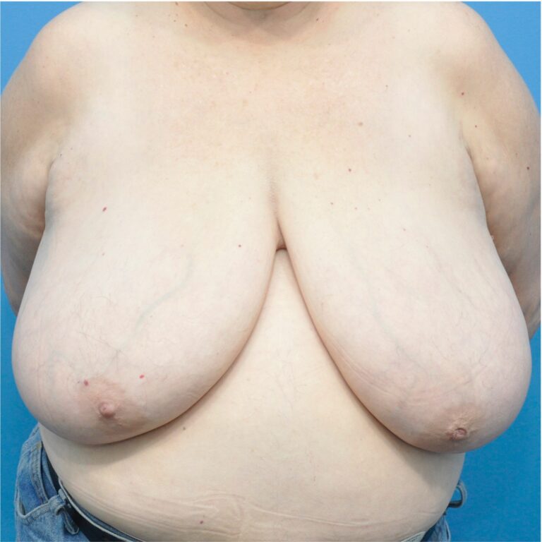 Procedure before and after - before