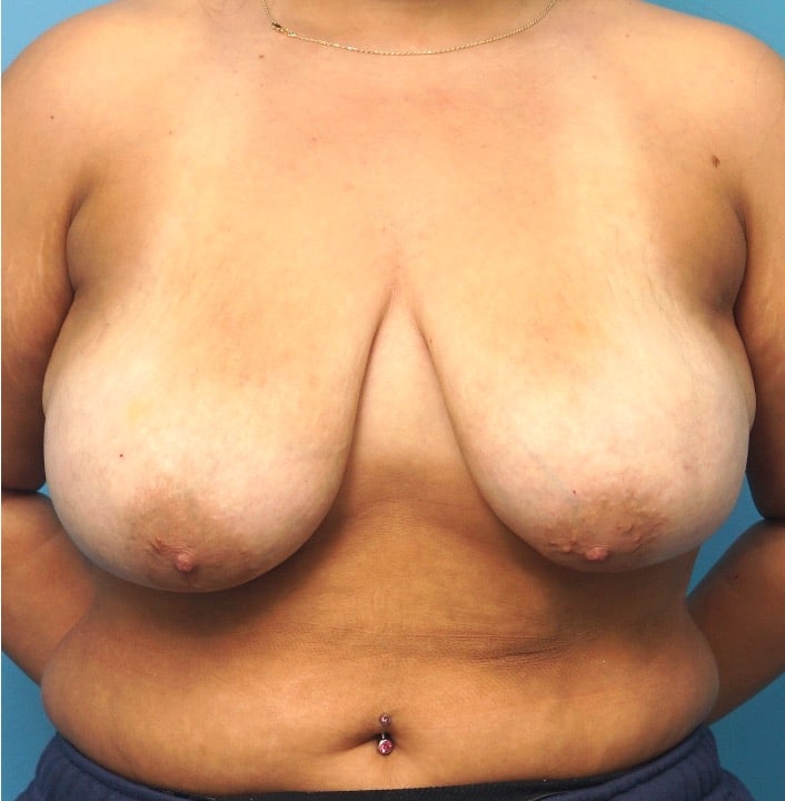 Procedure before and after - before