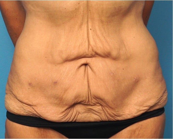 Tummy Tuck before and after - before