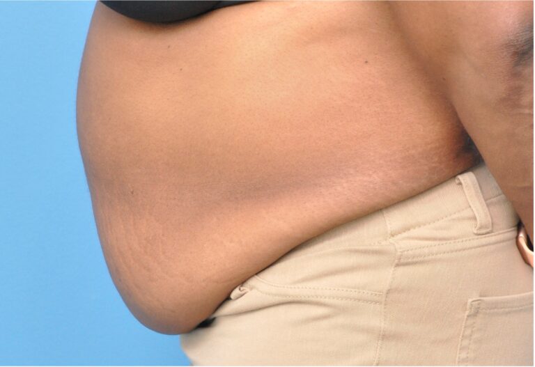 Tummy Tuck before and after - before